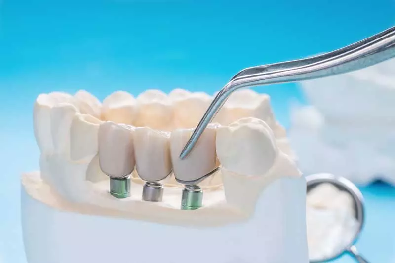 Breaking Myths: Debunking Common Misconceptions About Dental Implants