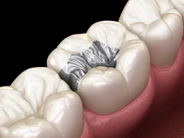 dental filling 3